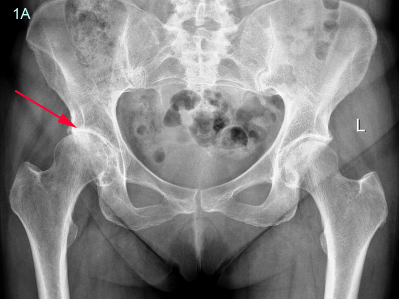 Example of Osteoarthritis of the Hip Joint showing no joint space compared with the left hip