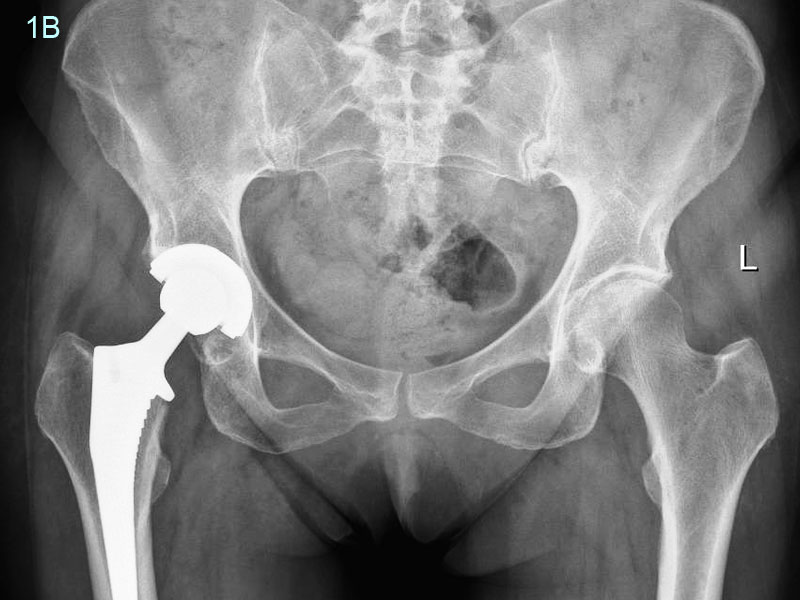 image of right hip Right Hip Replacement 12 months after surgery Patients doing very well