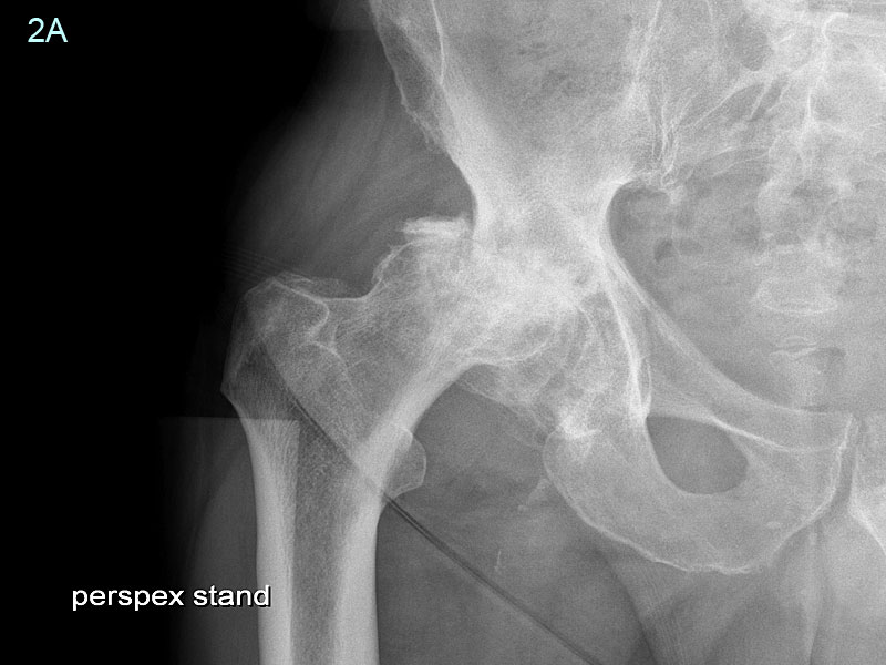 right hip pain and leg shortening showing the need for bone graft to reconstruct acetabulum socket