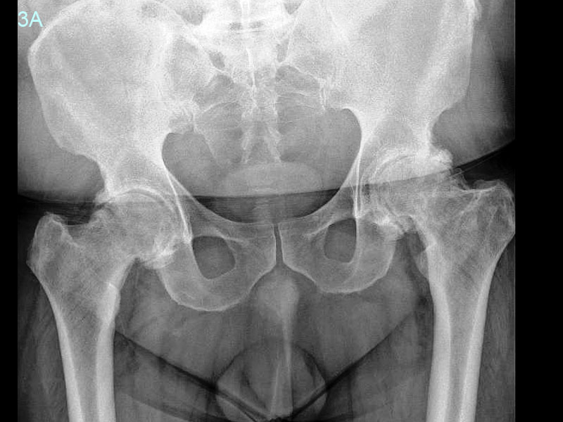 MC Radiographs showing advanced arthritis of both hips and the femoral heads have been destroyed. Both hips required replacement