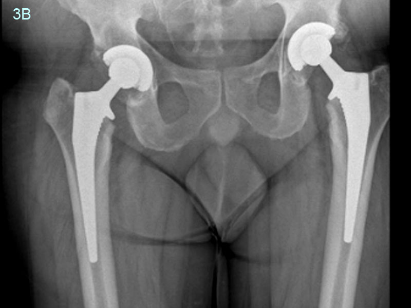 MC Post operative radiographs at 9 years after replacement of both hips using uncemented hips