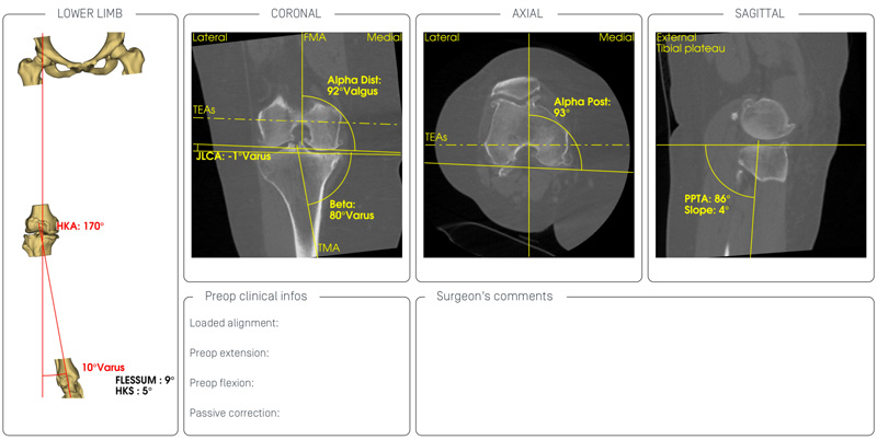 Symbios Knee Planning from CT Scan