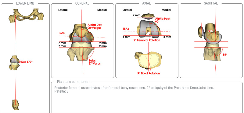 bespoke spoke hip and knee plant surgery at the North west hip and knee clinic performed by Mr Aslam Mohammed