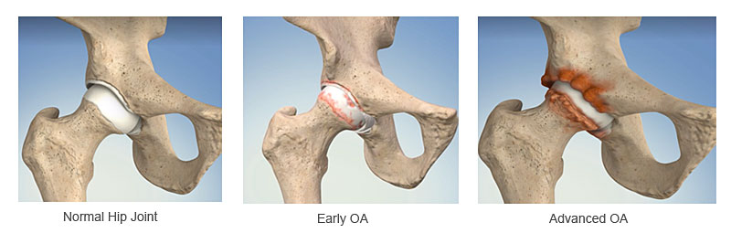 images showing normal hip early and advanced stages of hip arthritis