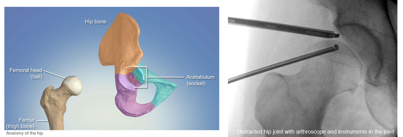 hip anatomy - the hip joint showing femoral head femur and acetabulum and the use of hip arthroscopy in a distracted hip joint