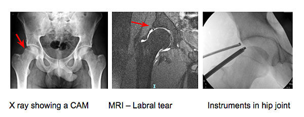 Hip injuries showing a CAM in hip - MRI labral tear and arthroscopy instruments in the hip joint - Mr Aslam Mohammed UK hip surgeon