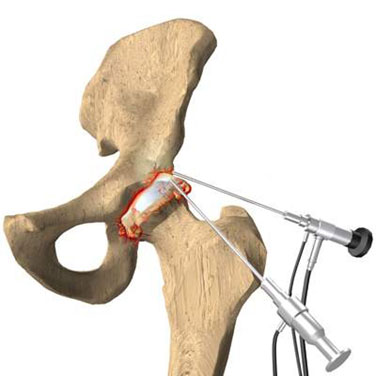 knee arthroscopy instruments used in the treatment of hip problems