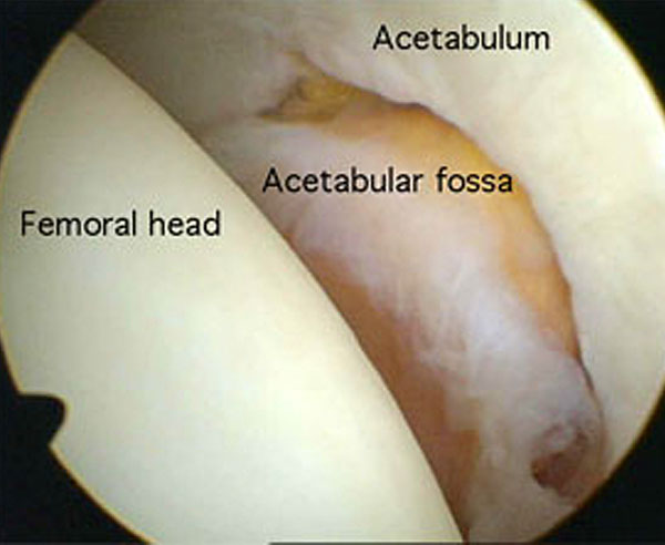  hip arthroscopy inside the hip joint showing femoral head acetabular fossa and Acetabulum