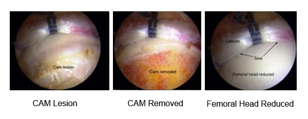 hip arthroscopy showing repaired labrum and CAM removed