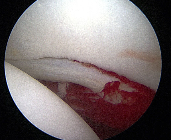  hip arthroscopy image of hip joint showing damage labral tear