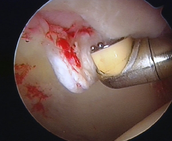 Arthroscopy of the hip image showing damage to the articular cartilage