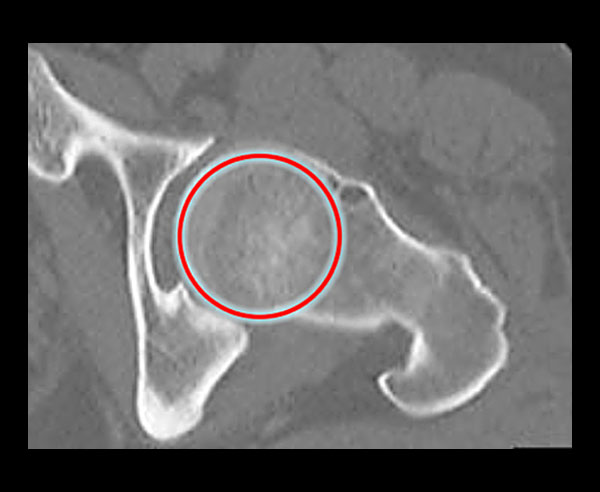  CT Scan of the hip