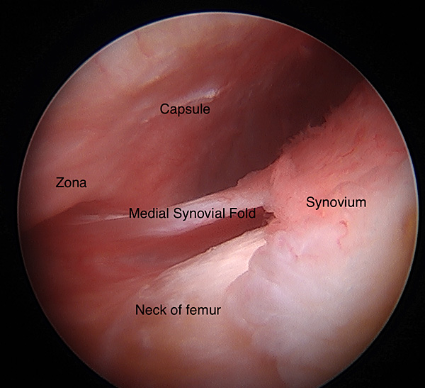 HIP SYNOVIAL FIOLDS of the hip peripheral compartment