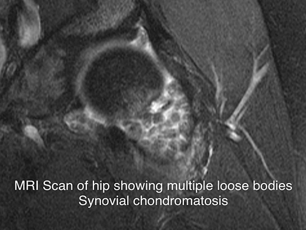 MRI scan showing multiple loose bodies called synovial chondromatosis