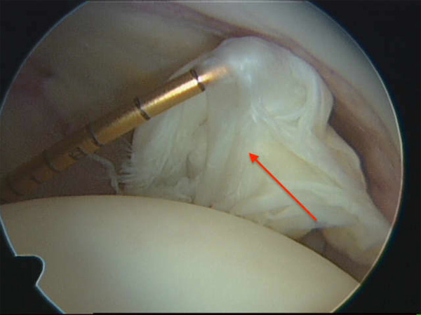 hip  injury image of a complete tear of the ligamentum in a gymnast