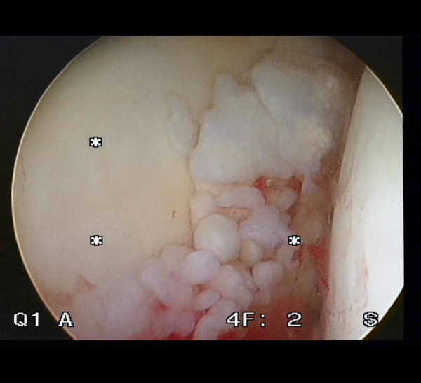 Image of hip Synovial chondromatosis 