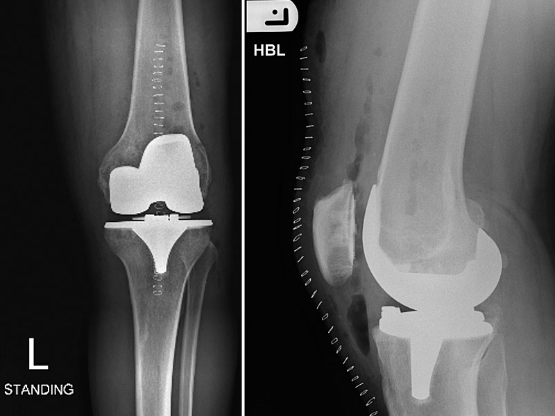 knee arthrtis knee problems knee replacement surgery by Mr Aslam Mohammed varus deformity corrected and patella knee cap resurfaced