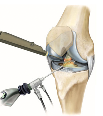 knee arthroscopy instruments