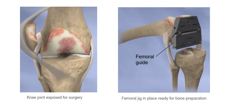 total knee replacent how is a TKS done