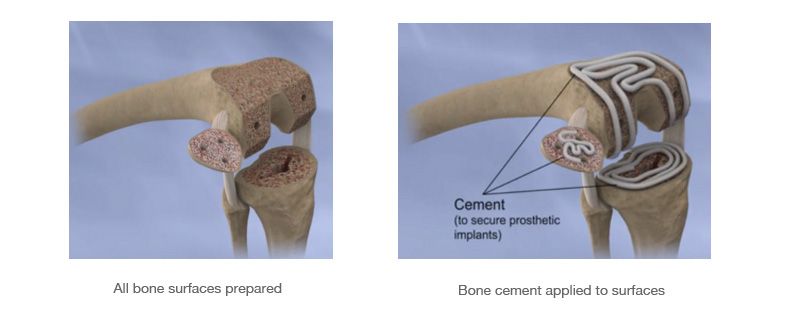 TKR placement images showing the process involved in total knee replacement
