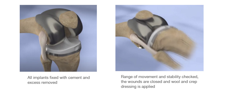 joint replacement illustation showing total knee replacement procedure