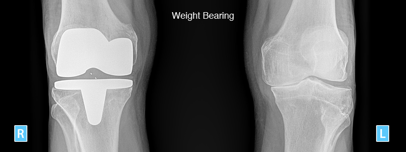 MRI scan of a total knee replacement performed by mr aslam mohammed north west hip knee clinic